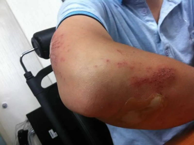 Have You Suffered An Injury Recently